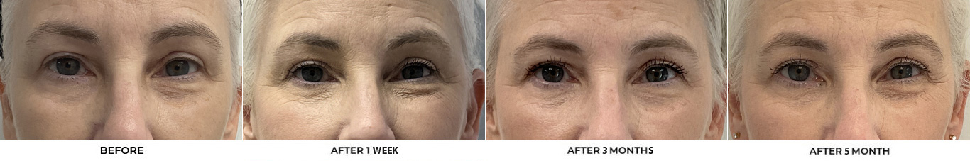 59 year old woman who was bothered by her jawline contour. She underwent radiofrequency-assisted liposuction with FaceTite for improvement of the submental region and jawline. After photos obtained 3 months post-procedure, results typically last 5-7 years.				