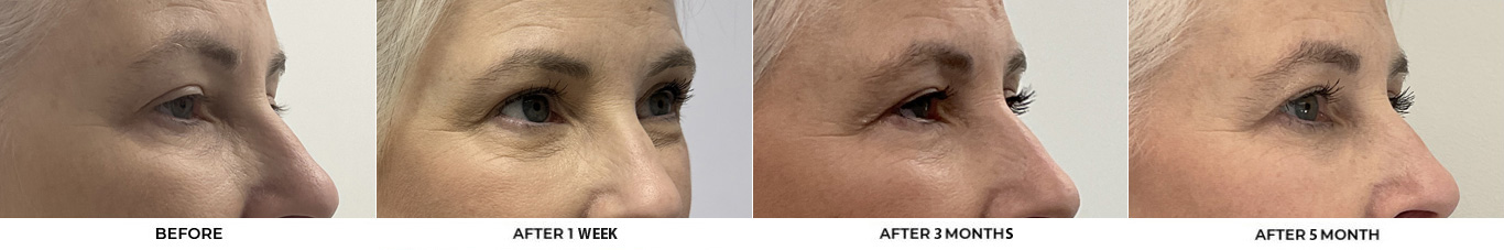 59 year old woman who was bothered by her jawline contour. She underwent radiofrequency-assisted liposuction with FaceTite for improvement of the submental region and jawline. After photos obtained 3 months post-procedure, results typically last 5-7 years.				