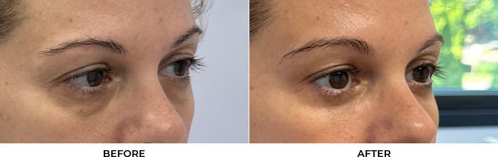 51 year old woman who was bothered by the appearance of her lower eyelids. She underwent transconjunctival lower eyelid blepharoplasty with fat transposition, skin pinch, and CO2 resurfacing. After photos were obtained 6 months post-procedure. Results can last 10 years.				