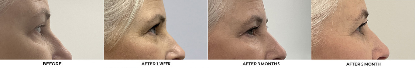 59 year old woman who was bothered by her jawline contour. She underwent radiofrequency-assisted liposuction with FaceTite for improvement of the submental region and jawline. After photos obtained 3 months post-procedure, results typically last 5-7 years.				