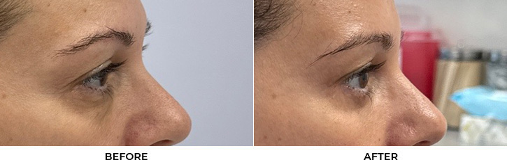 51 year old woman who was bothered by the appearance of her lower eyelids. She underwent transconjunctival lower eyelid blepharoplasty with fat transposition, skin pinch, and CO2 resurfacing. After photos were obtained 6 months post-procedure. Results can last 10 years.				