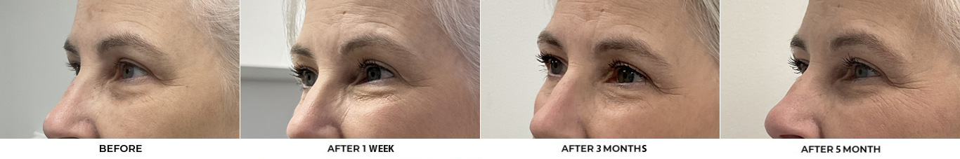 59 year old woman who was bothered by her jawline contour. She underwent radiofrequency-assisted liposuction with FaceTite for improvement of the submental region and jawline. After photos obtained 3 months post-procedure, results typically last 5-7 years.				