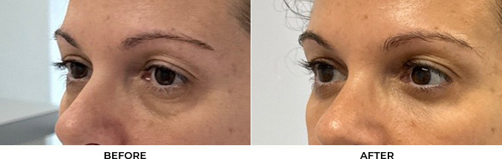 51 year old woman who was bothered by the appearance of her lower eyelids. She underwent transconjunctival lower eyelid blepharoplasty with fat transposition, skin pinch, and CO2 resurfacing. After photos were obtained 6 months post-procedure. Results can last 10 years.				