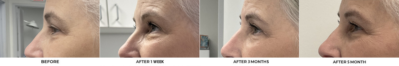 59 year old woman who was bothered by her jawline contour. She underwent radiofrequency-assisted liposuction with FaceTite for improvement of the submental region and jawline. After photos obtained 3 months post-procedure, results typically last 5-7 years.				