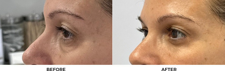 51 year old woman who was bothered by the appearance of her lower eyelids. She underwent transconjunctival lower eyelid blepharoplasty with fat transposition, skin pinch, and CO2 resurfacing. After photos were obtained 6 months post-procedure. Results can last 10 years.				