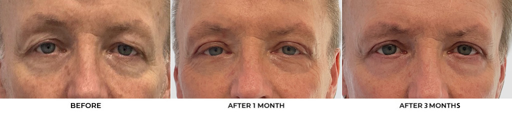 60 year old man who was bothered by the appearance of his upper eyelids. He underwent upper eyelid blepharoplasty with CO2 resurfacing around the eyelids. After photos were obtained 1 month and 3 months post-procedure. Results typically last 7-10 years.				