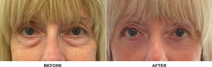 70 year old woman who was bothered by the appearance of her lower eyelids. She underwent transconjunctival lower eyelid blepharoplasty with fat transposition and skin pinch. After photos were obtained 6 months post-procedure.				