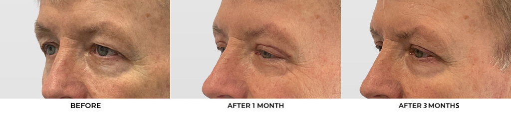 60 year old man who was bothered by the appearance of his upper eyelids. He underwent upper eyelid blepharoplasty with CO2 resurfacing around the eyelids. After photos were obtained 1 month and 3 months post-procedure. Results typically last 7-10 years.				