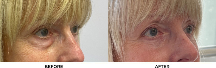 70 year old woman who was bothered by the appearance of her lower eyelids. She underwent transconjunctival lower eyelid blepharoplasty with fat transposition and skin pinch. After photos were obtained 6 months post-procedure.				