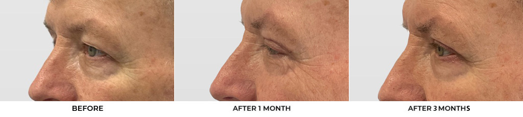 60 year old man who was bothered by the appearance of his upper eyelids. He underwent upper eyelid blepharoplasty with CO2 resurfacing around the eyelids. After photos were obtained 1 month and 3 months post-procedure. Results typically last 7-10 years.				