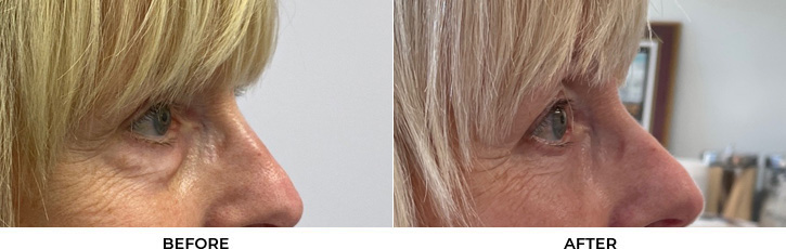 70 year old woman who was bothered by the appearance of her lower eyelids. She underwent transconjunctival lower eyelid blepharoplasty with fat transposition and skin pinch. After photos were obtained 6 months post-procedure.				