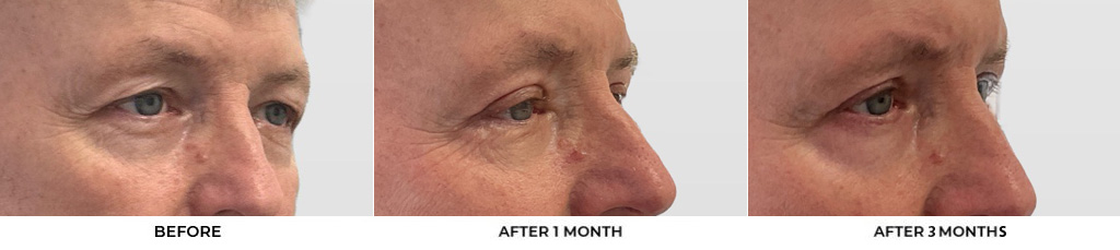 60 year old man who was bothered by the appearance of his upper eyelids. He underwent upper eyelid blepharoplasty with CO2 resurfacing around the eyelids. After photos were obtained 1 month and 3 months post-procedure. Results typically last 7-10 years.				