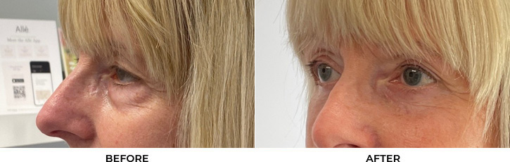 70 year old woman who was bothered by the appearance of her lower eyelids. She underwent transconjunctival lower eyelid blepharoplasty with fat transposition and skin pinch. After photos were obtained 6 months post-procedure.				