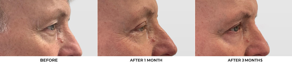 60 year old man who was bothered by the appearance of his upper eyelids. He underwent upper eyelid blepharoplasty with CO2 resurfacing around the eyelids. After photos were obtained 1 month and 3 months post-procedure. Results typically last 7-10 years.				