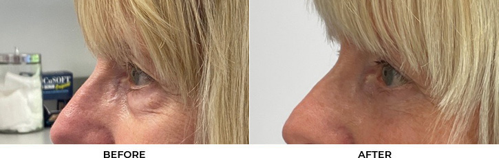 70 year old woman who was bothered by the appearance of her lower eyelids. She underwent transconjunctival lower eyelid blepharoplasty with fat transposition and skin pinch. After photos were obtained 6 months post-procedure.				