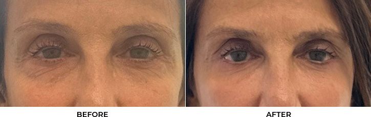 65 year old woman who was bothered by the appearance of her lower eyelids. She underwent lower eyelid blepharoplasty and CO2 resurfacing. After photos were obtained 3 months post-procedure.				