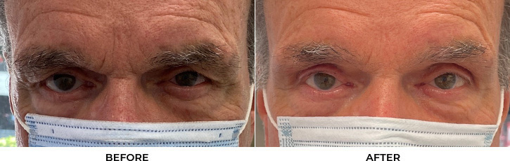 78 year old man who was bothered by the appearance of his upper eyelids. He underwent upper eyelid blepharoplasty. After photos were obtained 3 months post-procedure.				