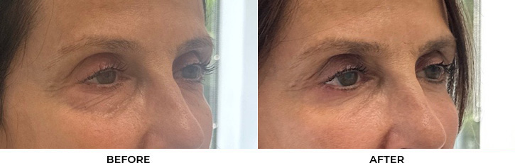 65 year old woman who was bothered by the appearance of her lower eyelids. She underwent lower eyelid blepharoplasty and CO2 resurfacing. After photos were obtained 3 months post-procedure.				