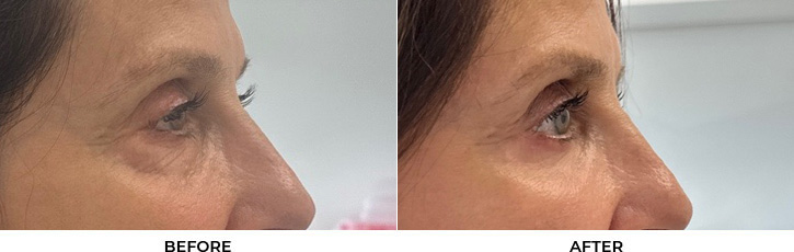 65 year old woman who was bothered by the appearance of her lower eyelids. She underwent lower eyelid blepharoplasty and CO2 resurfacing. After photos were obtained 3 months post-procedure.				