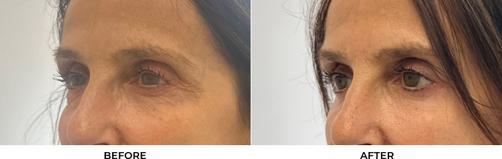 65 year old woman who was bothered by the appearance of her lower eyelids. She underwent lower eyelid blepharoplasty and CO2 resurfacing. After photos were obtained 3 months post-procedure.				