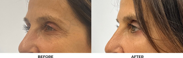 65 year old woman who was bothered by the appearance of her lower eyelids. She underwent lower eyelid blepharoplasty and CO2 resurfacing. After photos were obtained 3 months post-procedure.				