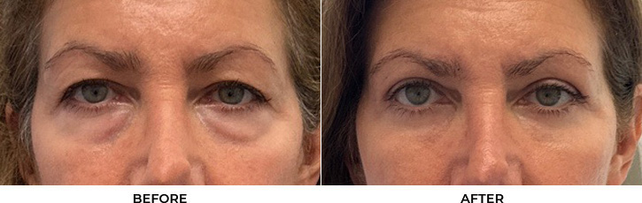 56 year old woman who was bothered by her upper and lower eyelid appearance. She underwent upper and lower eyelid blepharoplasty with fat transposition, periocular CO2 resurfacing, and Morpheus8 treatment. After photos are shown at 3 months post-surgery.				