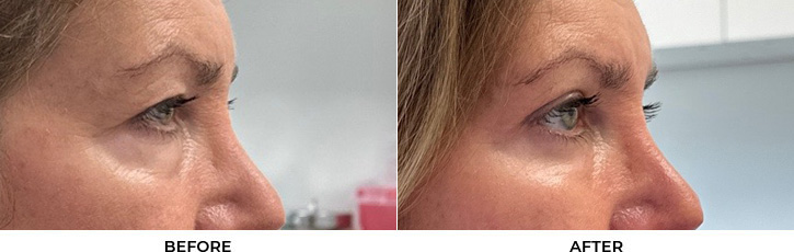56 year old woman who was bothered by her upper and lower eyelid appearance. She underwent upper and lower eyelid blepharoplasty with fat transposition, periocular CO2 resurfacing, and Morpheus8 treatment. After photos are shown at 3 months post-surgery.				