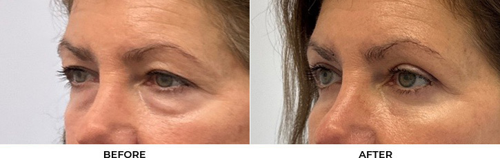 56 year old woman who was bothered by her upper and lower eyelid appearance. She underwent upper and lower eyelid blepharoplasty with fat transposition, periocular CO2 resurfacing, and Morpheus8 treatment. After photos are shown at 3 months post-surgery.				