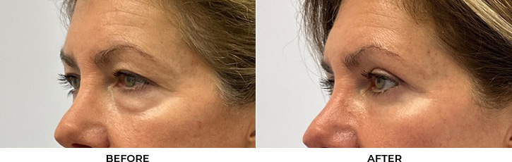 56 year old woman who was bothered by her upper and lower eyelid appearance. She underwent upper and lower eyelid blepharoplasty with fat transposition, periocular CO2 resurfacing, and Morpheus8 treatment. After photos are shown at 3 months post-surgery.				