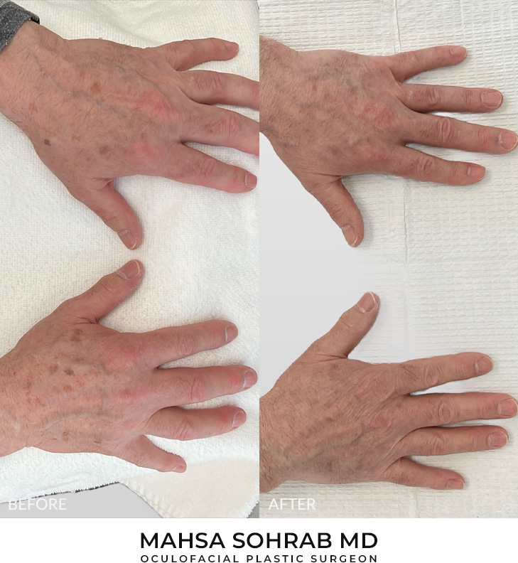 60 year old man bothered by discoloration on his hands. After photos obtained 2 months after a single BBL treatment.