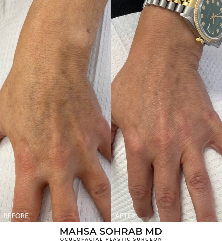 49 year old woman bothered by discoloration on the hands. After photos obtained 2 months after a single BBL treatment.