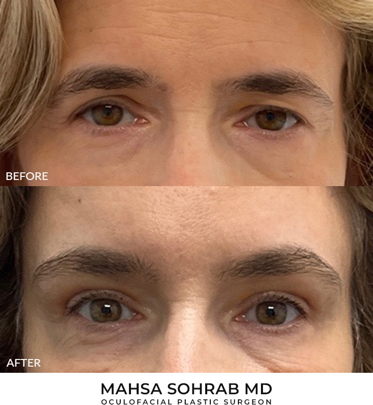53 year old woman who was bothered by heaviness of upper eyelids. She underwent upper blepharoplasty and endoscopic eyebrow and forehead lifting. After photos are 1 month post-procedure.