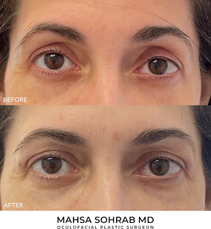 48 year old woman who was bothered by hollowing of the upper eyelids. She underwent filler placement to the upper eyelids. After photos are immediately post-treatment.
