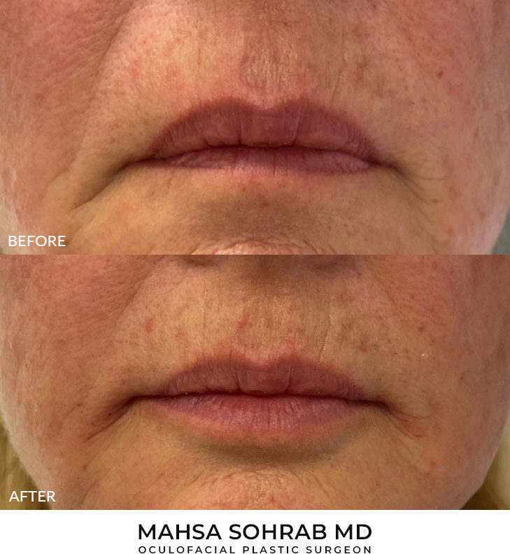 64 year old woman who was bothered by lip volume asymmetry. She underwent filler placement for lip augmentation. After photos are immediately post-treatment.