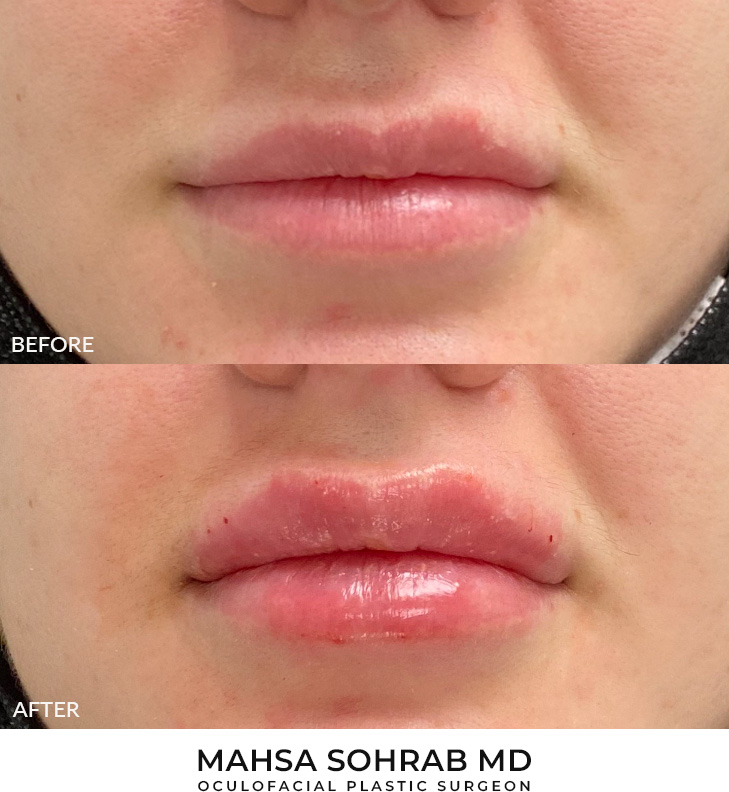 28 year old woman who was seeking larger lip volume. She underwent filler placement for lip augmentation. After photos are immediately post-treatment.