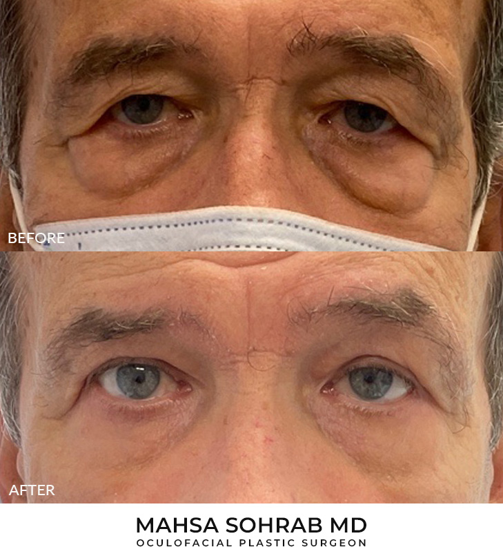 72 year old man who was bothered by the appearance of his upper and lower eyelids. He underwent upper and lower eyelid blepharoplasty and endoscopic brow lift. After photos are 3 months post-procedure. Results typically last 7-10 years.