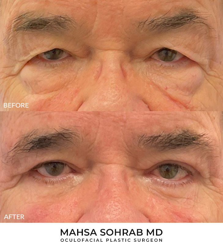 77 year old man who was bothered by the appearance of his upper and lower eyelids. He underwent upper and lower eyelid blepharoplasty with internal browpexy. After photos are 2 months post-procedure. Results typically last 7-10 years.