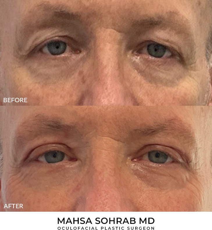 60 year old man who was bothered by the appearance of his upper eyelids. He underwent upper eyelid blepharoplasty with CO2 resurfacing around the eyelids. After photos were obtained 1 month and 3 months post-procedure. Results typically last 7-10 years.