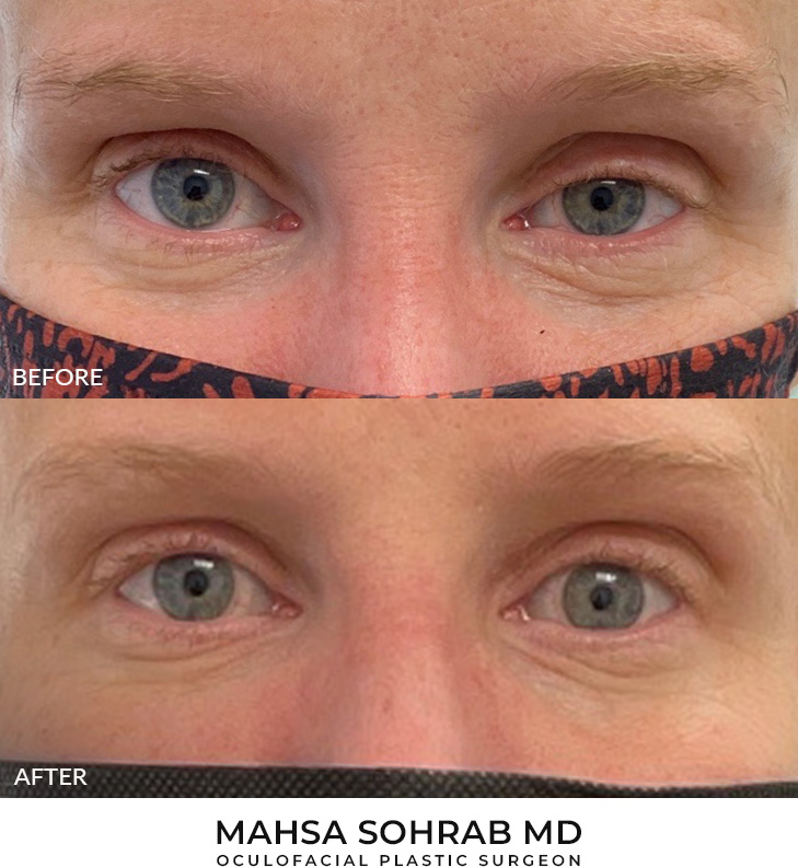 36 year old woman who was bothered by drooping of the left upper eyelid. She underwent internal ptosis repair. After photos are 1 month post-left upper eyelid ptosis repair. Results can last 10 years.