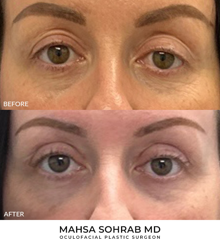 44 year old woman who was bothered by drooping of both upper eyelids and excess skin of both upper eyelids. She underwent bilateral external ptosis repair and blepharoplasty. After photos are 1 month post-bilateral upper eyelid ptosis repair and blepharoplasty. Results can last 10 years.