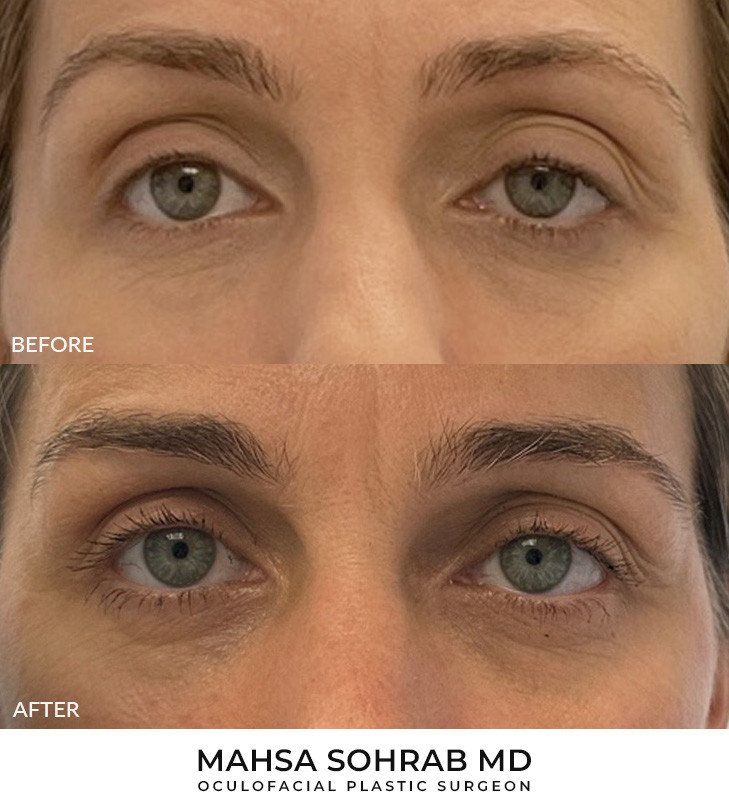 47 year old woman who was bothered by drooping of the left upper eyelid. She underwent internal ptosis repair. After photos are 9 months post-left upper eyelid internal ptosis repair. Results can last 10 years.