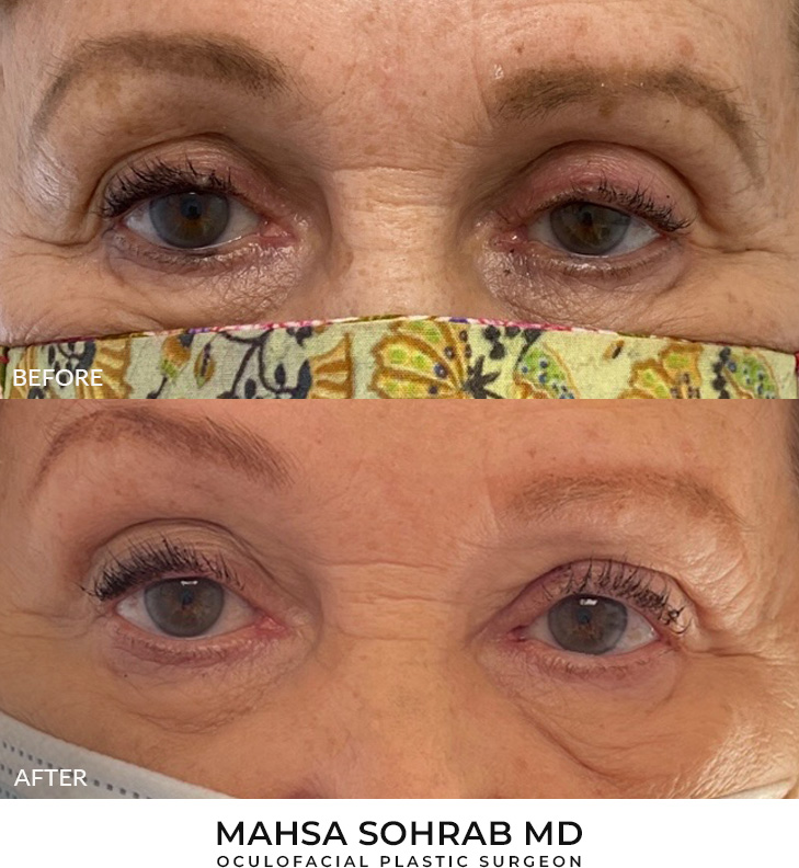 79 year old woman who was bothered by drooping of the left upper eyelid. She underwent left upper eyelid external ptosis repair. After photos are 2 months post-left upper eyelid external ptosis repair. Results can last 10 years.