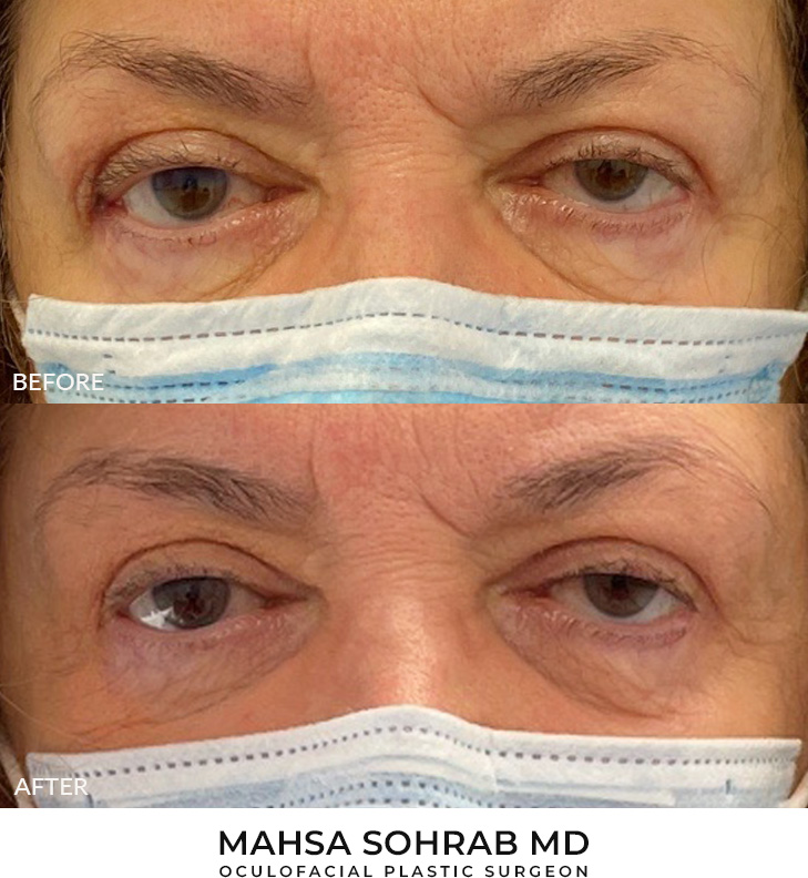 Revision Blepharoplasty Before and After Image
