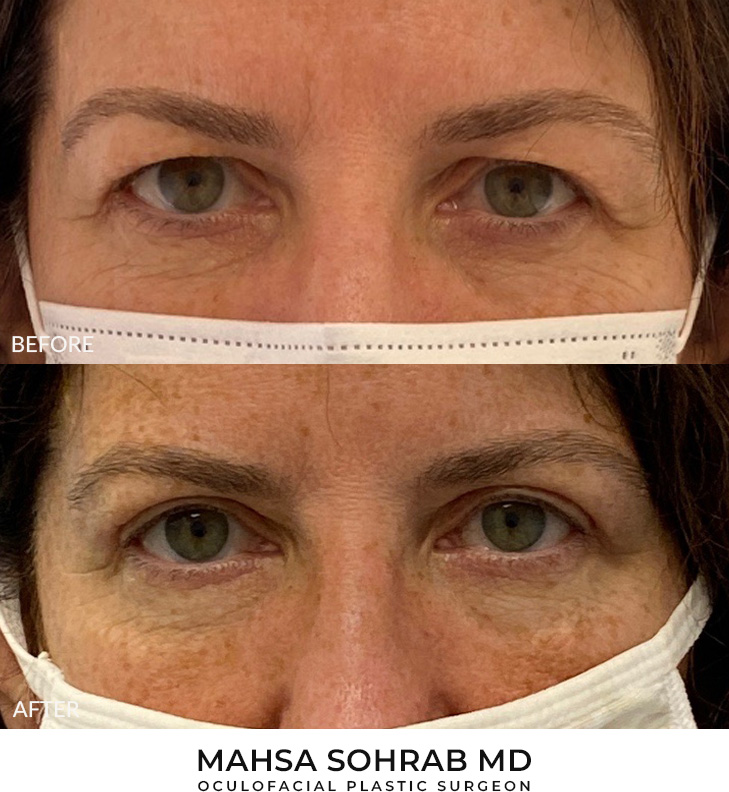 55 year old woman who was bothered by her upper eyelid appearance. She underwent upper eyelid blepharoplasty and internal browpexy. After photos show results at 3 months post-surgery.