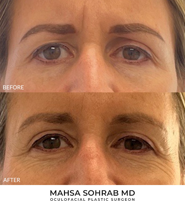 51 year old woman who was bothered by her upper eyelid appearance. She underwent upper eyelid blepharoplasty and internal browpexy. After photos show results at 3 months post-surgery.