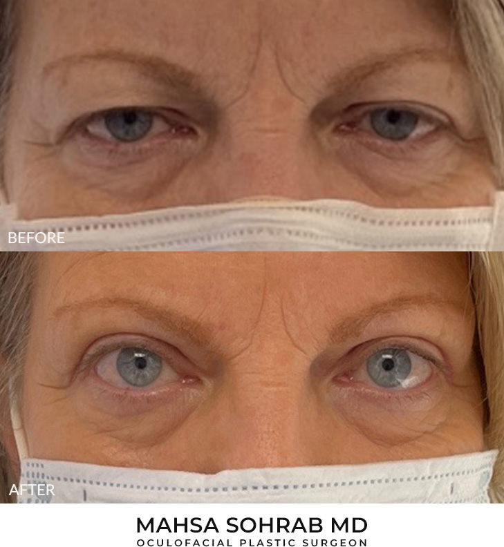 60 year old woman who was bothered by her upper eyelid appearance. She underwent upper eyelid blepharoplasty. After photos show results at 3 months post-surgery.