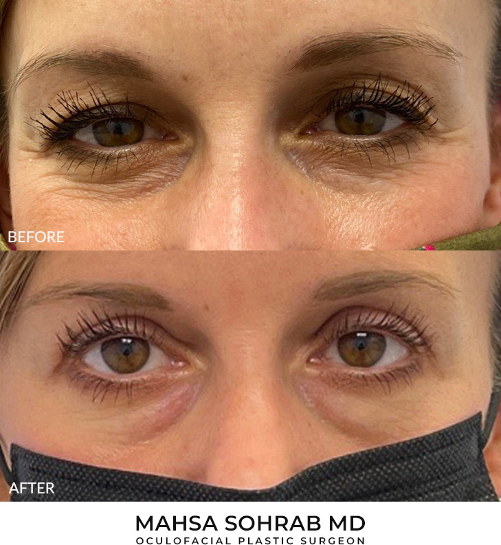 39 year old woman who was bothered by upper eyelid appearance. She underwent upper eyelid blepharoplasty in-office under local anesthesia. After photos were obtained 1-month post-surgery. Results can last 10 years.
