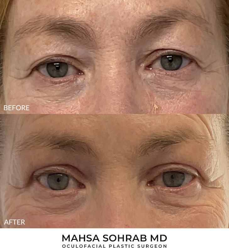 66 year old woman who was bothered by her upper eyelid appearance. She underwent upper eyelid blepharoplasty and internal browpexy. After photos show results at 1 month and 3 months post-surgery.