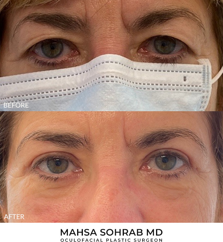 64 year old woman who was bothered by her upper eyelid appearance. She underwent upper eyelid blepharoplasty. After photos show results at 1 month post-surgery.