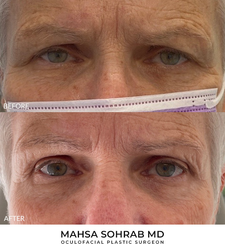 72 year old woman who was bothered by her upper eyelid appearance. She underwent upper eyelid blepharoplasty and internal browpexy. After photos show results at 3 months post-surgery.